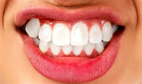 How To Treat Bruxism Symptoms Causes And Treatment