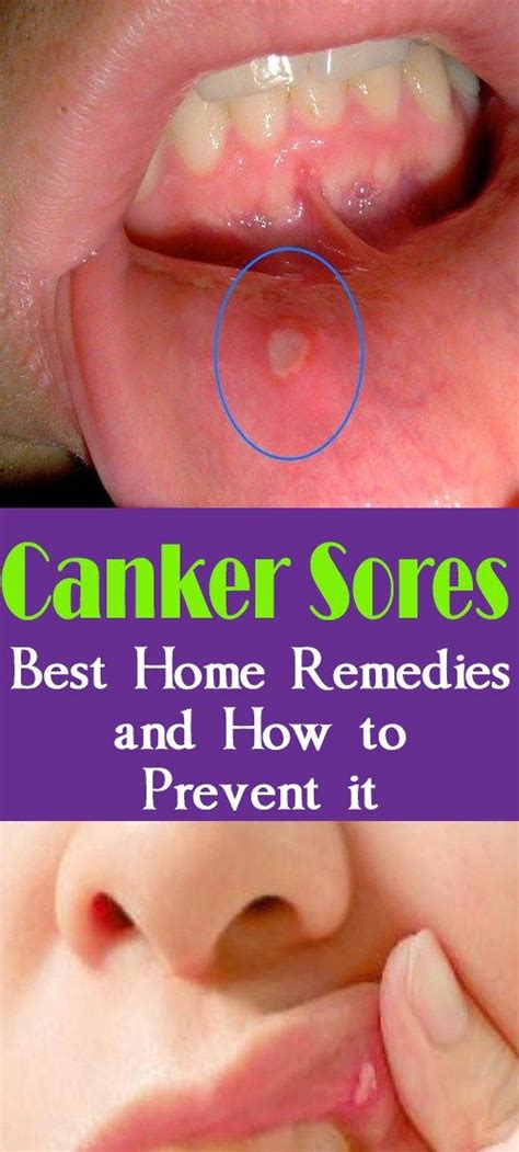 Canker Sores Best Home Remedies And How To Prevent It Canker Sore