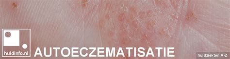 Maar we zijn daar zal morgen de huisarts of verloskundige bellen als we definitieve uitslag hebben van ons nichtje. Autoeczematisatie | huidinfo.nl | informatie van de ...
