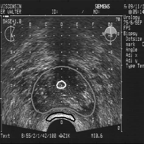 Transrectal Ultrasound Image Of The Prostate With The Regions Of Download Scientific Diagram