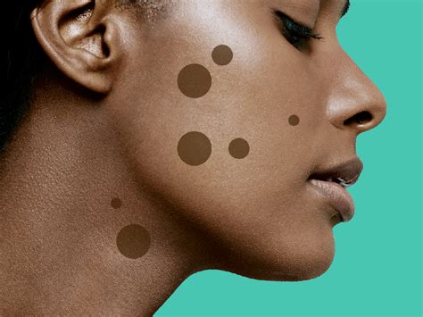 The Dark Spot Treatments That Really Work According To Dermatologists