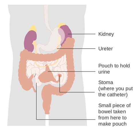 Bladder Cancer Condition CK Ng Urology Minimally Invasive Surgery