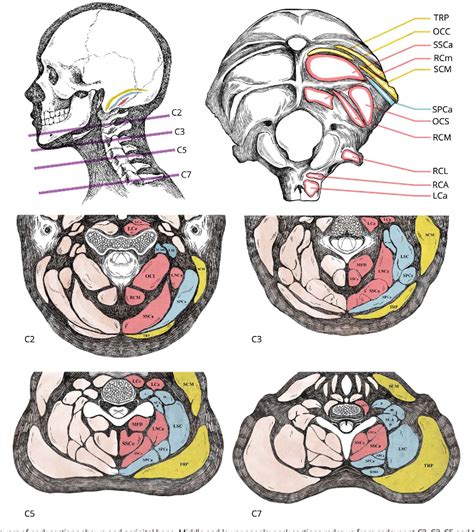 Figure 2 From Management Of Cervical Dystonia With Botulinum