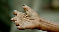 World Leprosy Day: India accounts for over half of 2 lakh cases ...