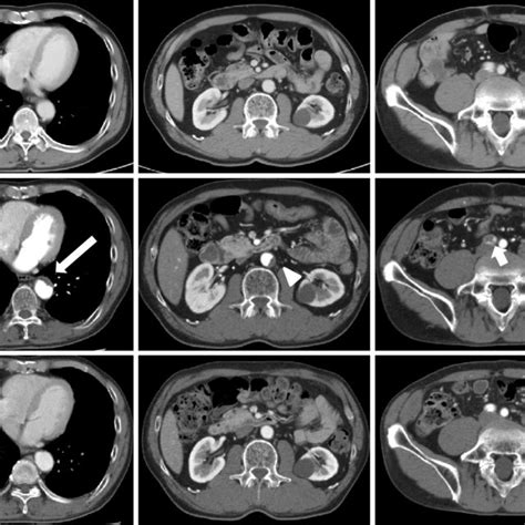 Figure3contrast Enhanced Computed Tomography Scans A At The