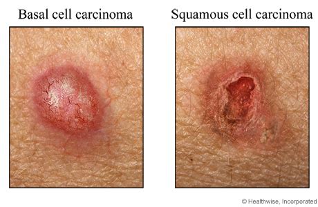 Basal And Squamous Cell Carcinoma Video Image