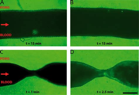 Mimicking Arterial Thrombosis In A 3d Printed Microfluidic In Vitro