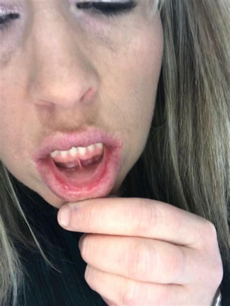 Bite Beauty Allergic Reactions Beauty Insider Community
