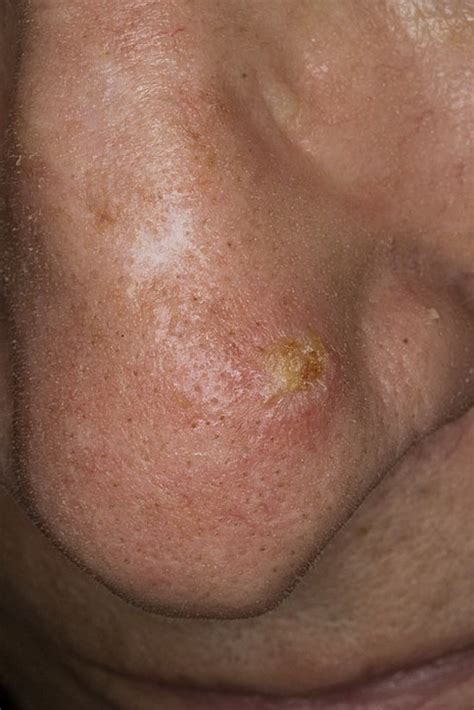 Early Signs Of Skin Cancer Pictures 15 Photos And Images