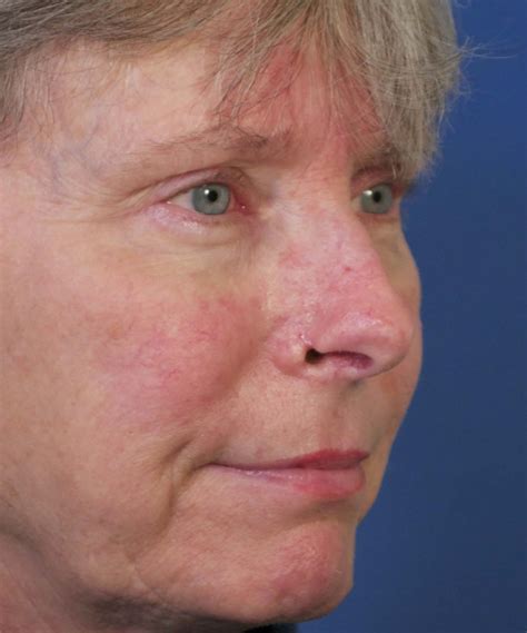 Nose Reconstruction After Mohs Cancer Dr Hilinski