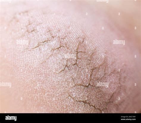 Dry Cracked Skin Stock Photos And Dry Cracked Skin Stock Images Alamy