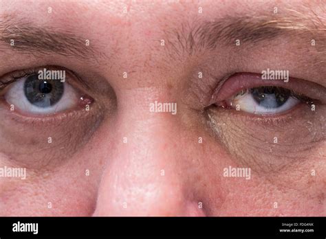 Close Up Of Eye Infection With Swollen Eyelid Stock Photo Alamy