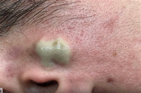 Treatment Of The Cyst Above The Ear Viral On The Web Now