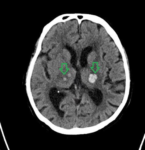 Cureus Spontaneous Simultaneous Bilateral Basal Ganglia Thalamic And Central Pontine