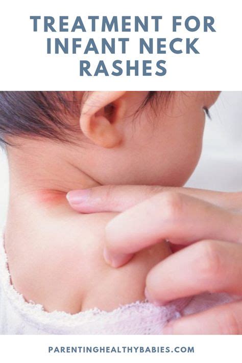 Baby Neck Rash In Infants Symptoms Home Remedies And Prevention