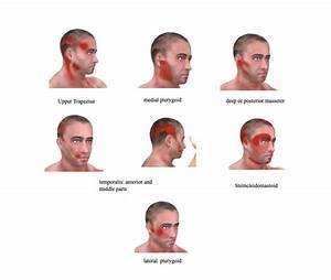 The Referred Patterns Of Relevant Neck And Head Muscles That Refer