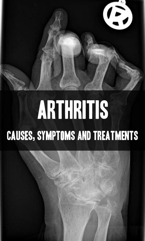 Arthritis Its Causes Symptoms And Treatments Available