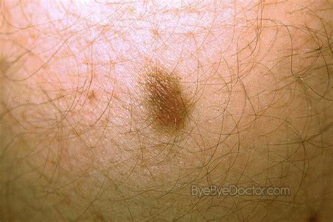Dermatofibroma Pictures Causes Removal And Treatment