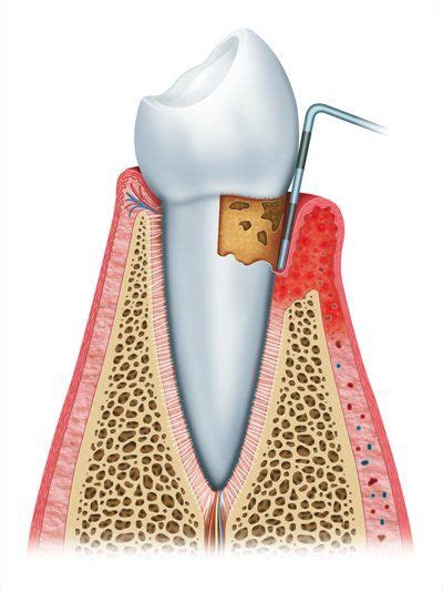 Gum Disease Treatment Periodontitis Treatment Tupelo MS