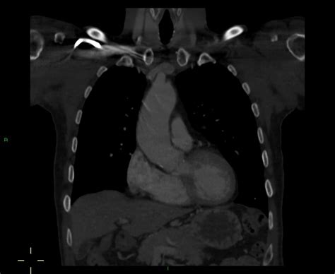 Aspirated Barium Swallow Radiology Case