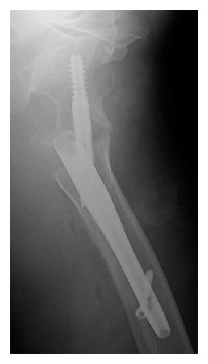 Radiographs After The Osteosynthesis Of The Left Trochanteric Fracture