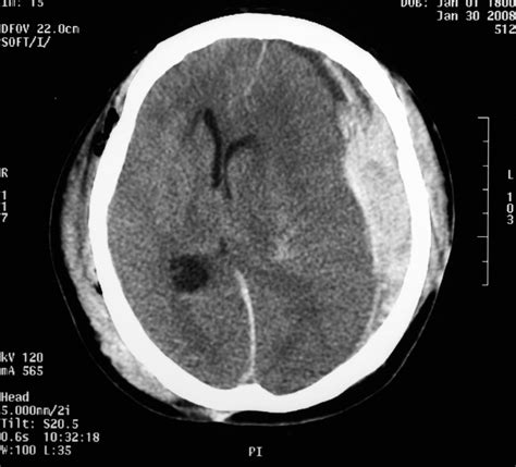 Ct Scan Showing Subdural Haemorrhage