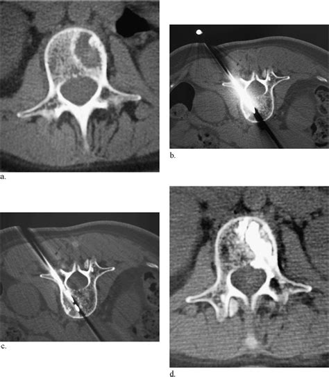 Lumbar Vertebral Metastasis From Breast Cancer A Axial Ct Image