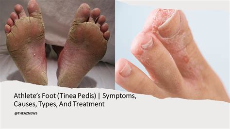 Athletes Foot Tinea Pedis Symptoms Causes Types And Treatment
