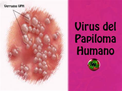 ¿cómo Saber Si Usted Padece Vph Virus De Papiloma Humano