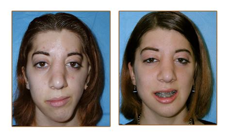 Craniofacial Surgery Picture Gallery Christopher T Johnson Dmd Facs