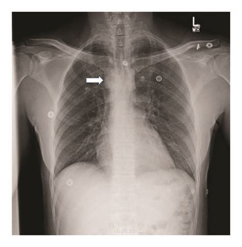 Postero Anterior View Of Chest X Ray Showing A Large Well Defined Right