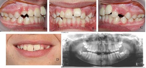 Phase 1 Completion A Intraoral Right Occlusion B Frontal