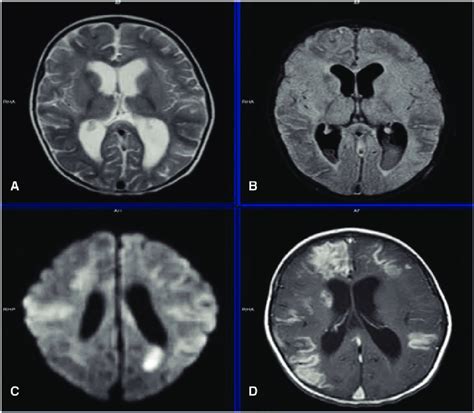 T2 Weighted A And Flair B Axial Mri Brain Images Show Hydrocephalus