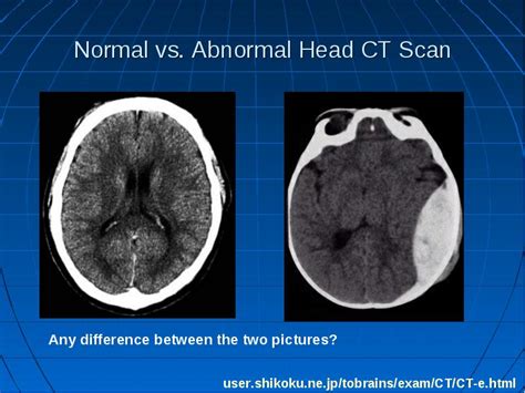 Abnormal Ct Scan Brain Normal Ct Scan Machine
