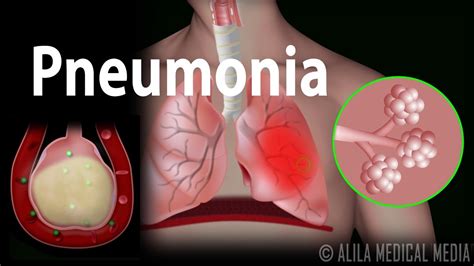 Pneumonia Animation Youtube