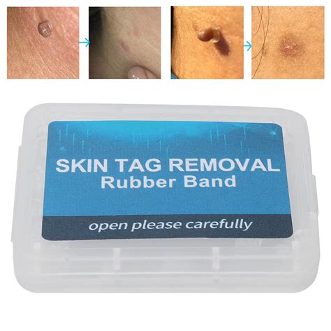 30pcs skin tag removal rubber bands safe micro band non toxic mole wart tou ebay