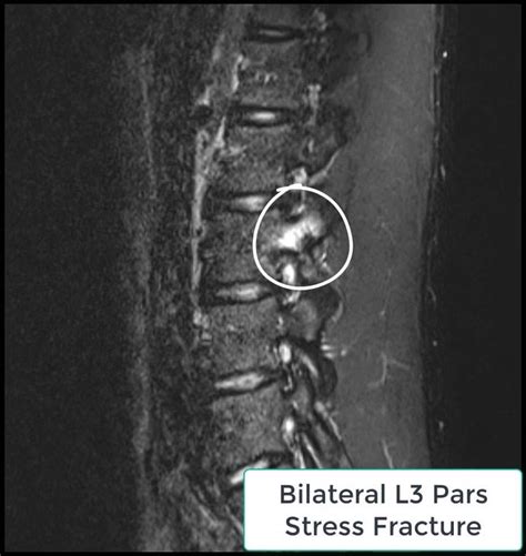 Bilateral L3 Pars Stress Fracture Bilateral L3 Pars Interarticularis