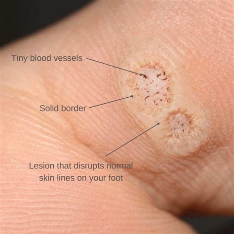 Plantar Warts Symptoms Causes Treatment And More Sexiz Pix