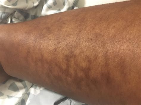 Sore Discolored Patch Of Skin Potential Causes Heidi Salon