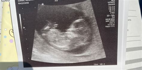Anterior Placenta And 12 Week Scan Babycentre