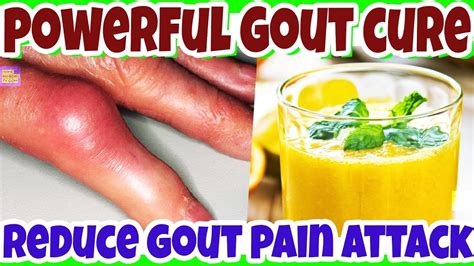Alternative treatments for gout, cure gout, natural with progress, other pharmaceutical drugs for how to cure gout developed from allopathic medicine. Stop GOUT ATTACK & GOUT PAIN Naturally, This NATURAL CURES ...