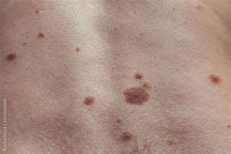 Melanocytic Nevus Some Of Them Dyplastic Or Atypical On A Caucasian
