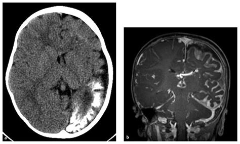 Hemispherectomy Neupsy Key