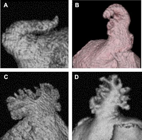 Percutaneous Left Atrial Appendage Occlusion For Stroke Prevention In