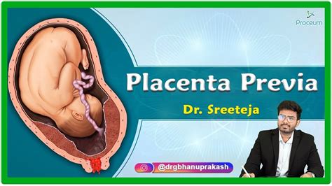 Understanding Placenta Previa Causes Risks And Management