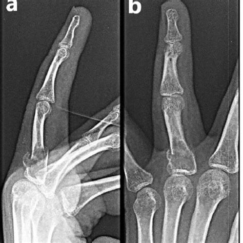 Follow Up Radiographs Of The Left Ring Finger At Two Months Showing A