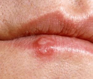 It is hard to say what the white bumps are without seeing them. Bumps on Lips Pictures, White, Sores, Itchy, inside ...