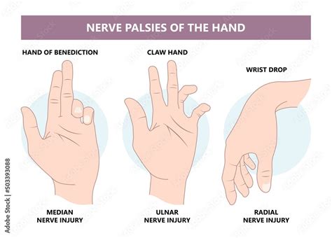 Ulnar Nerve Palsy Hand Sexiz Pix