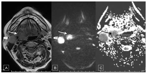 Cancers Free Full Text Predictive Value Of Early Post Treatment