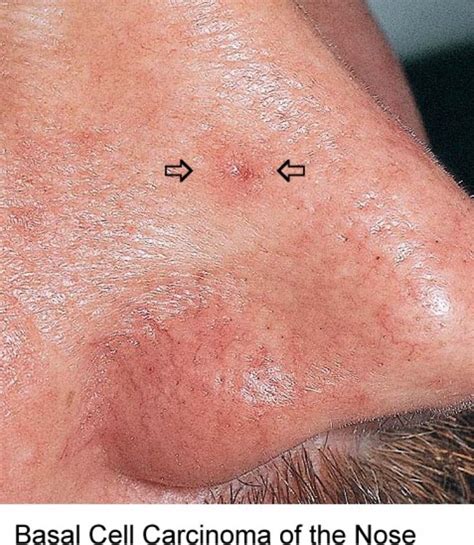 Skin Cancer Inside Nose Symptoms
